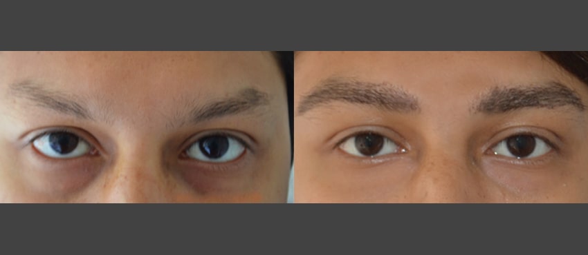 eyebrow restoration before and after image 1