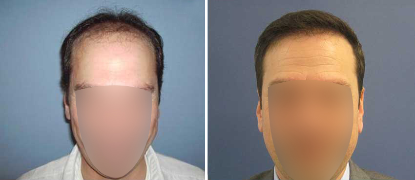 DHI before & after hair transplant results