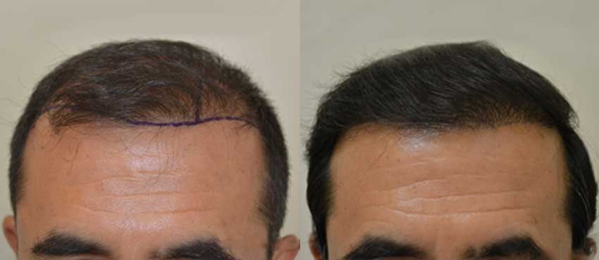 DHI before & after hair transplant results