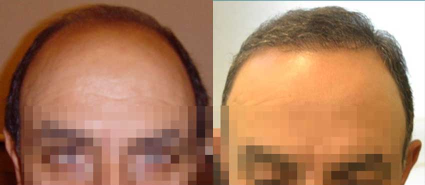 DHI before & after hair transplant results