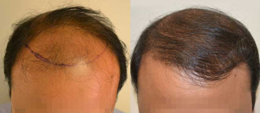 DHI before & after hair transplant results