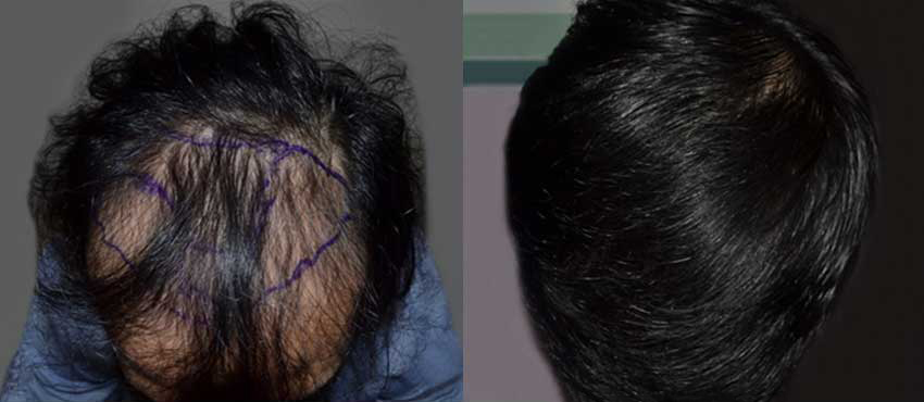 DHI before & after hair transplant results