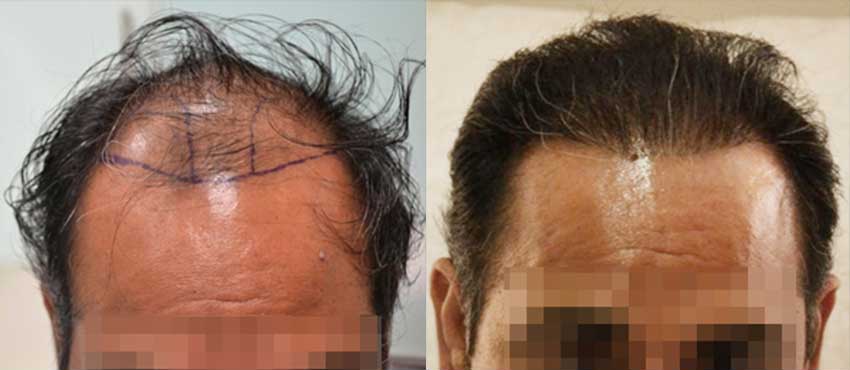 DHI before & after hair transplant results