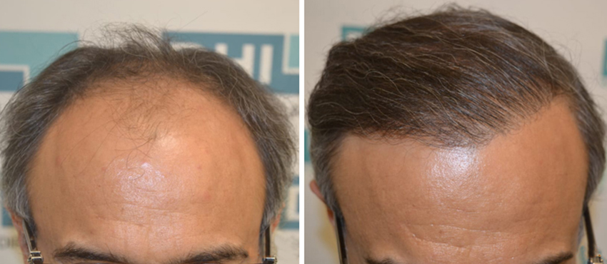 DHI before & after hair transplant results