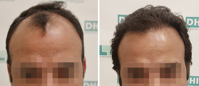 DHI before & after hair transplant results