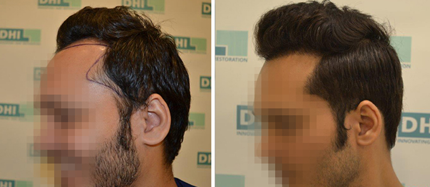DHI before & after hair transplant results