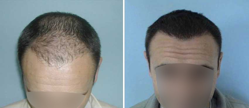 DHI before & after hair transplant results