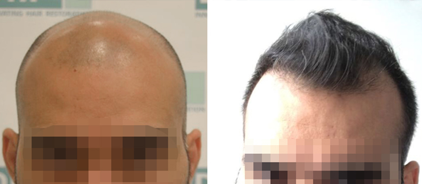 DHI before & after hair transplant results