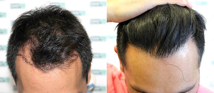 DHI before & after hair transplant results