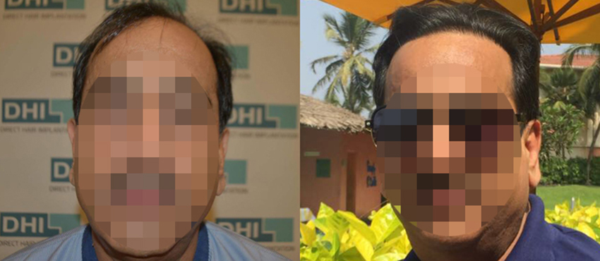 DHI before & after hair transplant results