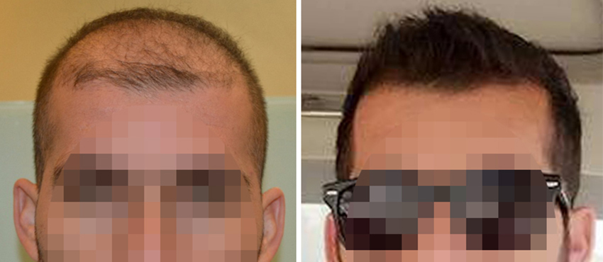 DHI before & after hair transplant results