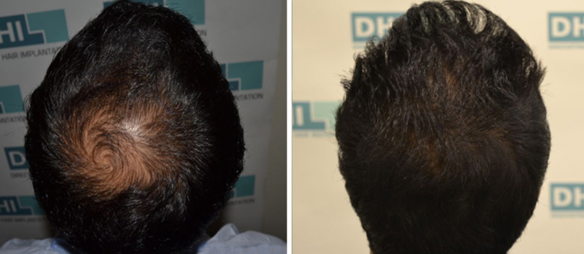 DHI before & after hair transplant results