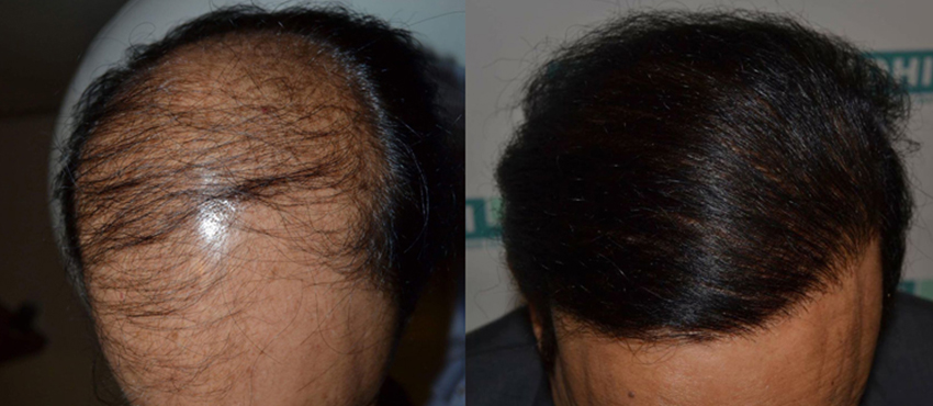 DHI before & after hair transplant results