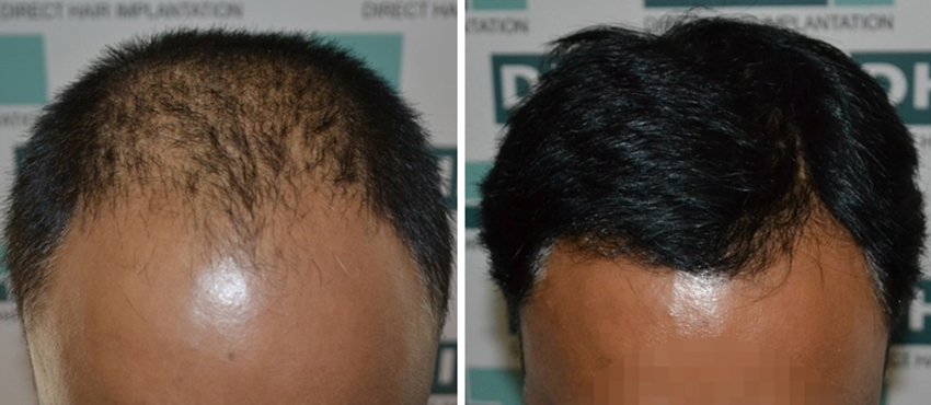 DHI before & after hair transplant results