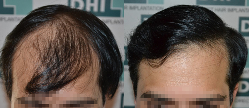 DHI before & after hair transplant results