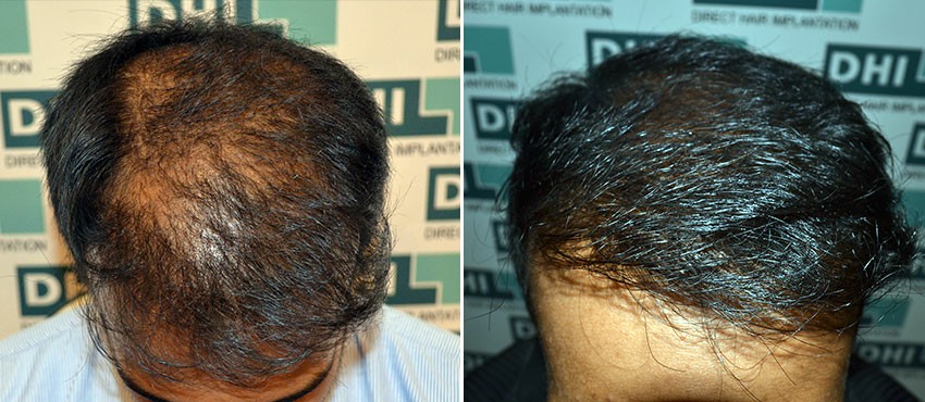 DHI before & after hair transplant results