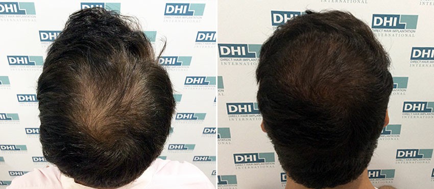 DHI before & after hair transplant results