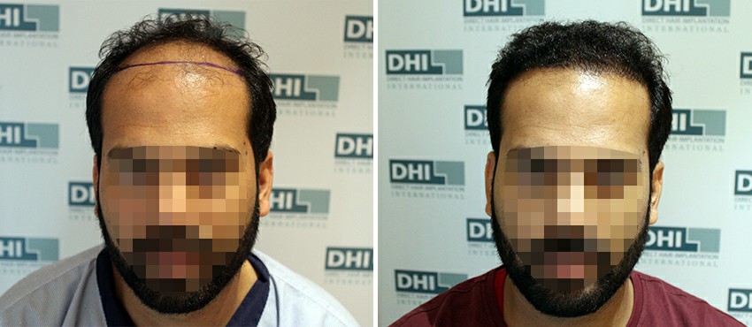 DHI before & after hair transplant results