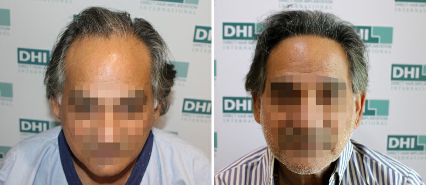 DHI before & after hair transplant results