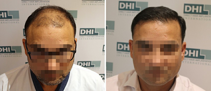 DHI before & after hair transplant results