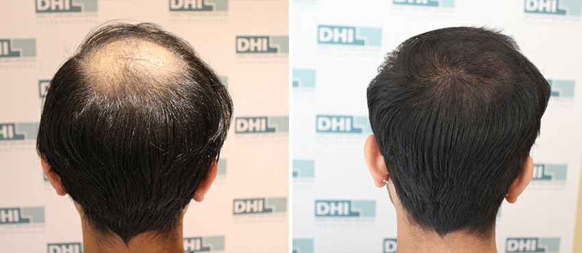 DHI before & after hair transplant results