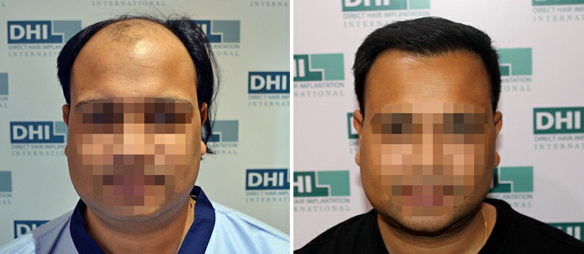 DHI before & after hair transplant results