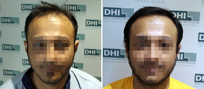 DHI before & after hair transplant results