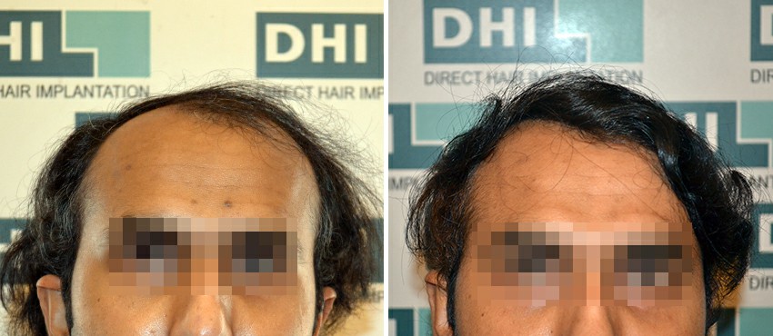 DHI before & after hair transplant results