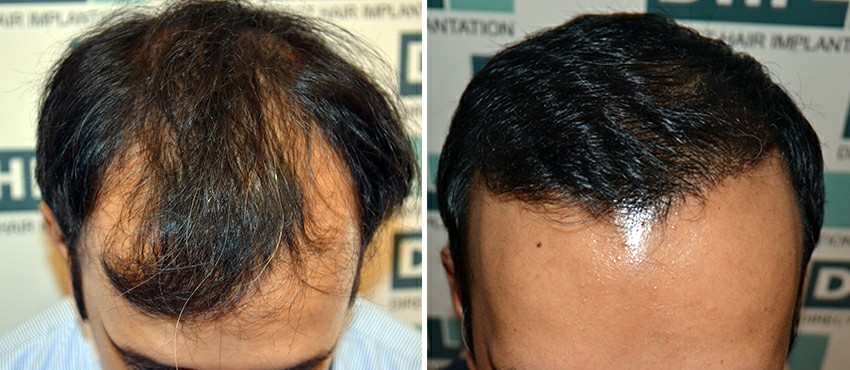 DHI before & after hair transplant results