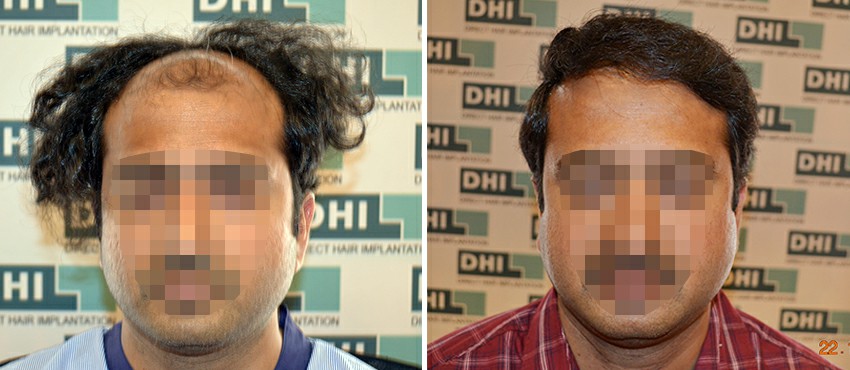 DHI before & after hair transplant results