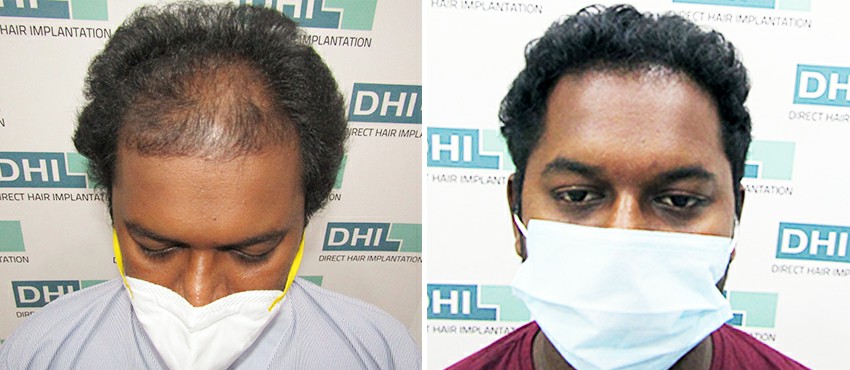 DHI before & after hair transplant results