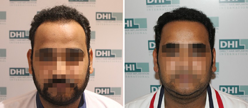 DHI before & after hair transplant results