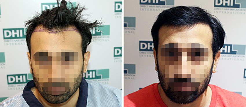 DHI before & after hair transplant results