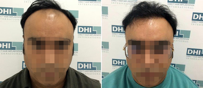 DHI before & after hair transplant results