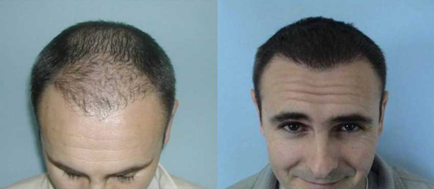 DHI before & after hair transplant results
