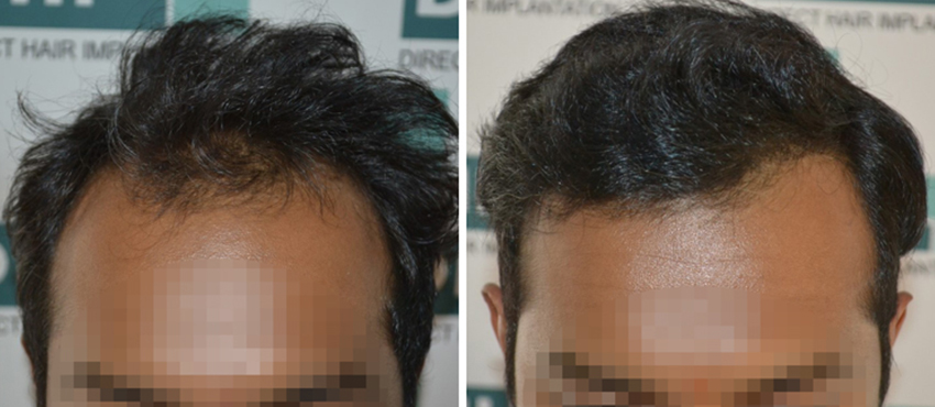 DHI before & after hair transplant results