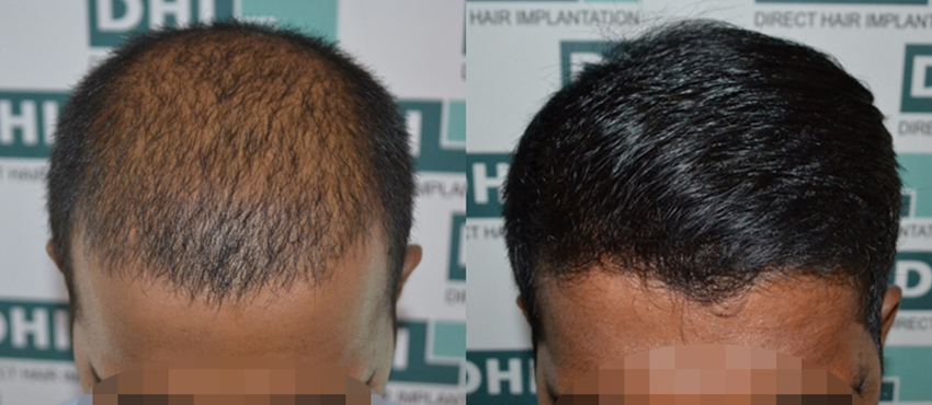 DHI before & after hair transplant results