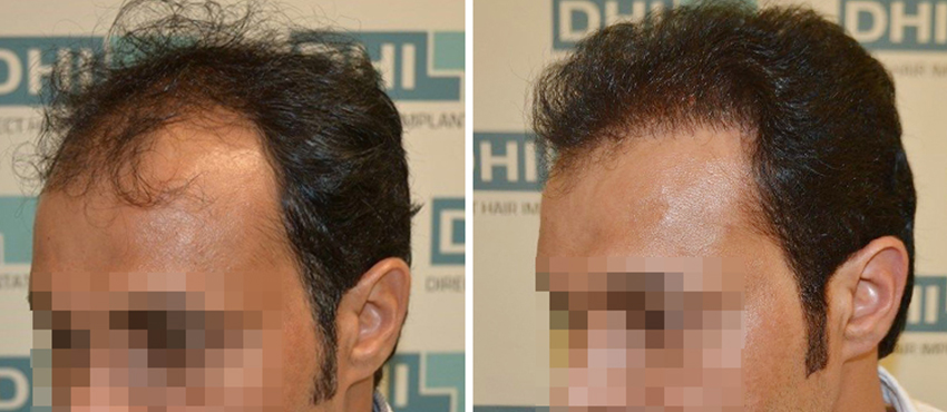 DHI before & after hair transplant results