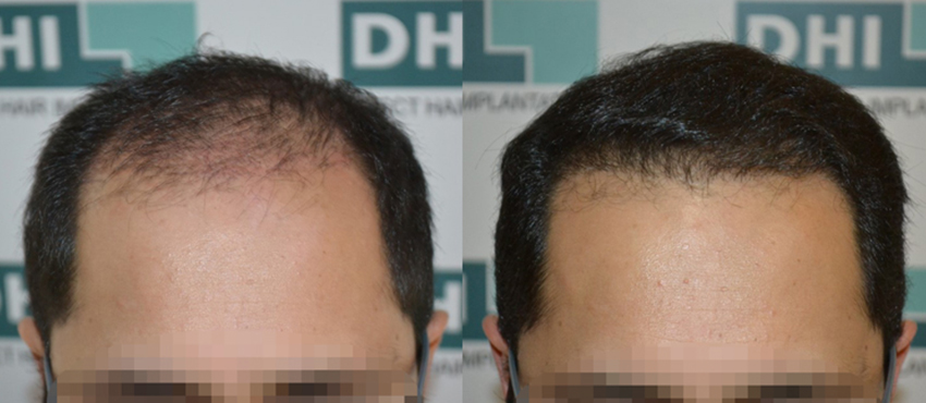 DHI before & after hair transplant results