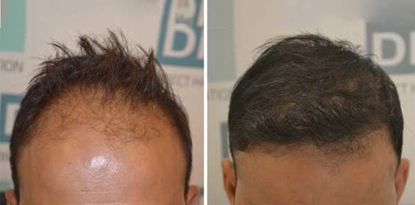 DHI before & after hair transplant results