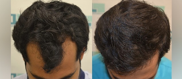 DHI before & after hair transplant results