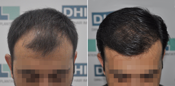 DHI before & after hair transplant results