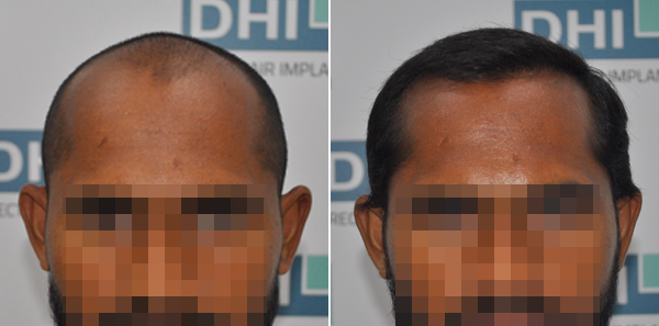 DHI before & after hair transplant results