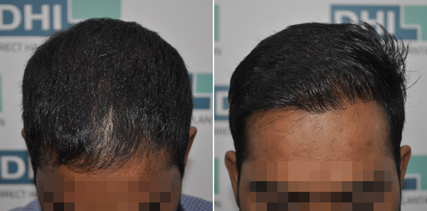 DHI before & after hair transplant results