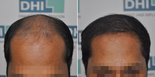 DHI before & after hair transplant results