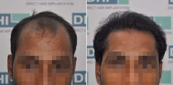 DHI before & after hair transplant results