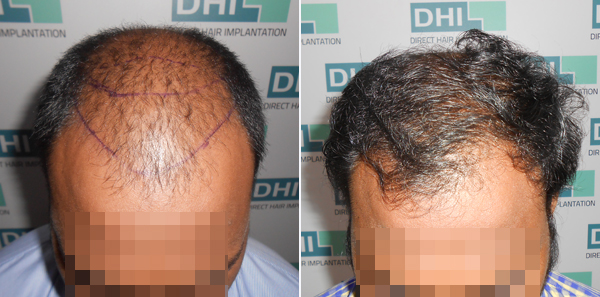 DHI before & after hair transplant results