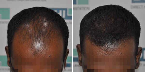 DHI before & after hair transplant results