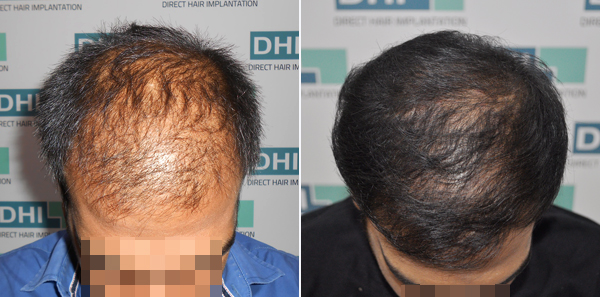 DHI before & after hair transplant results