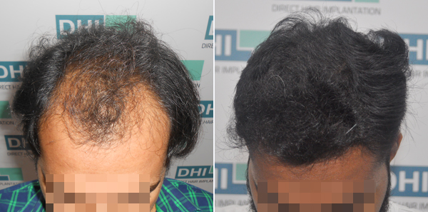 DHI before & after hair transplant results